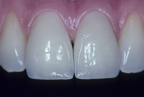 Porcelain Veneers