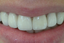 Porcelain Veneers