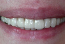Porcelain Veneers