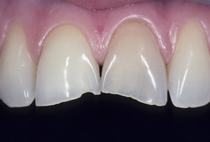 Porcelain Veneers