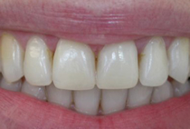 Porcelain Veneers