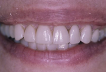 Porcelain Veneers